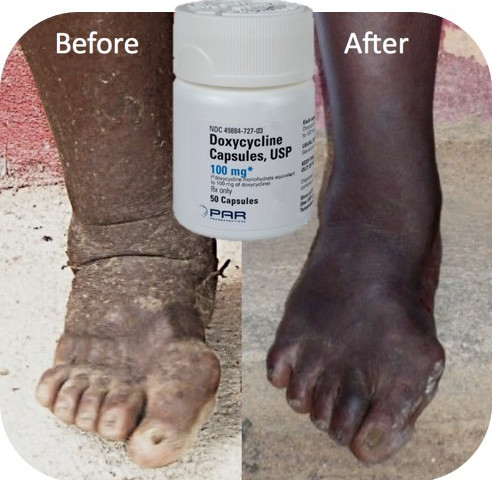 Before and After Doxycycline