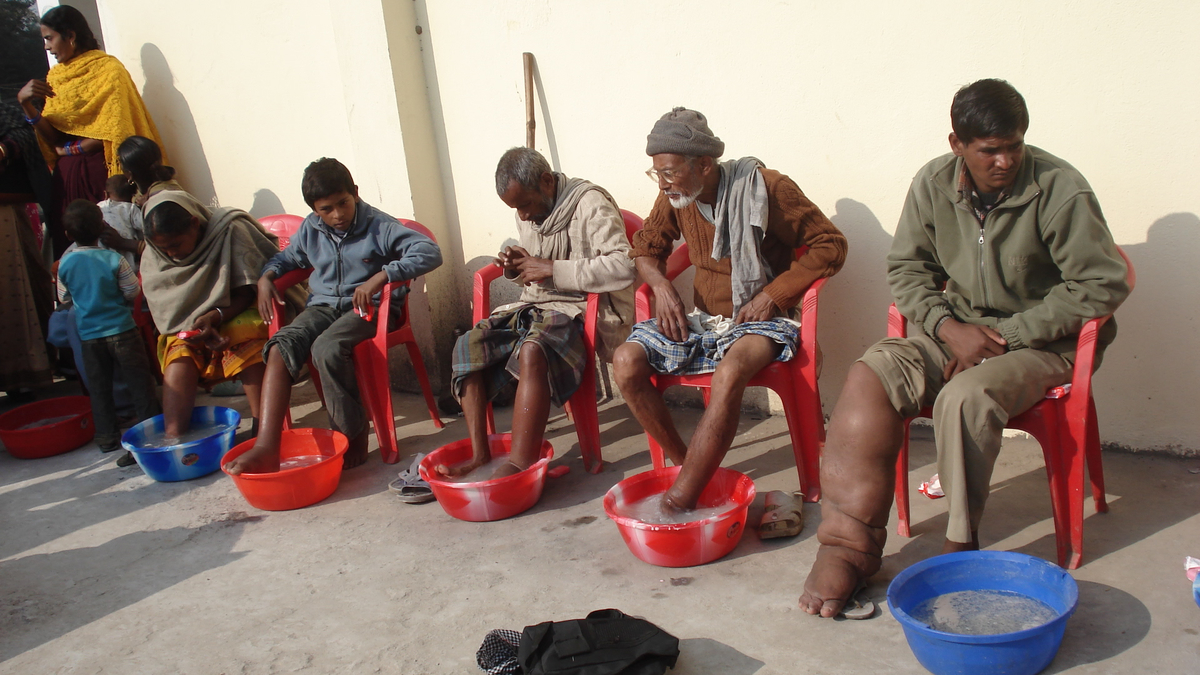 Visible symptoms of Lymphatic Filariasis