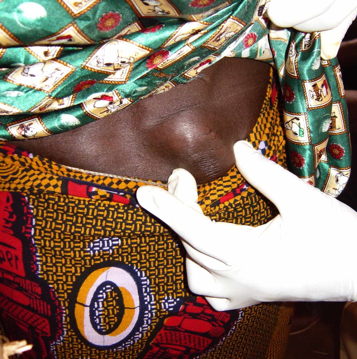 Onchocerciasis hip nodule